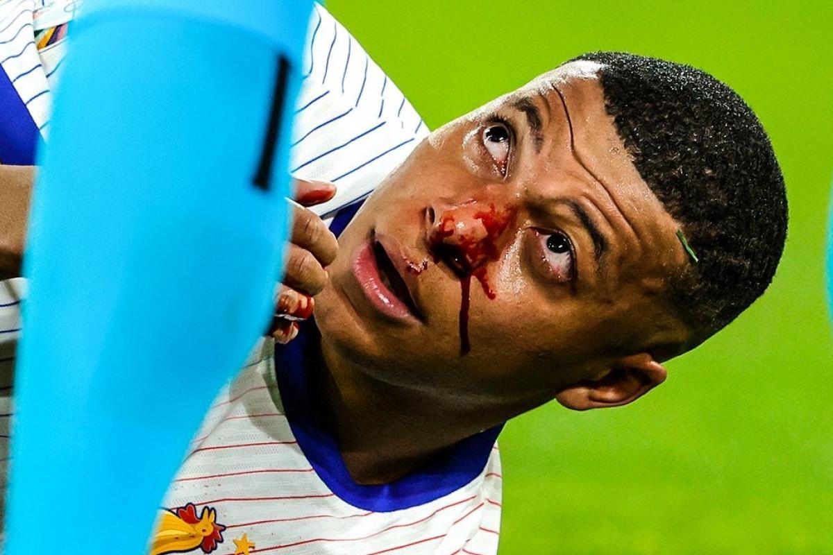 VIDEO | Así fue la impactante fractura de Mbappé: ¿se pierde la Eurocopa?